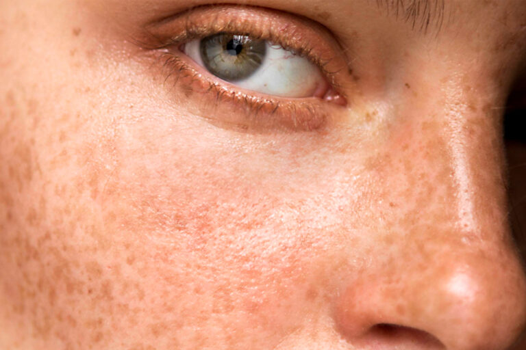 Melasma é uma condição que se caracteriza pelo aparecimento de manchas escuras na pele